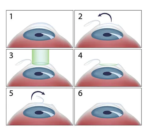 Basics Of Laser Refractive Surgery – Refractive laser surgery