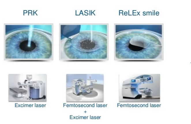 Basics Of Laser Refractive Surgery – DIFFERNECE IN PRK/LASIK/SMILE PROCEDURE