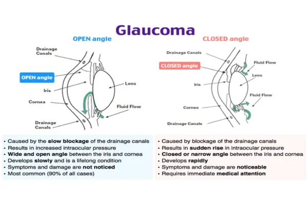 Glaucoma