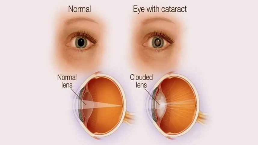 Cataract illustration