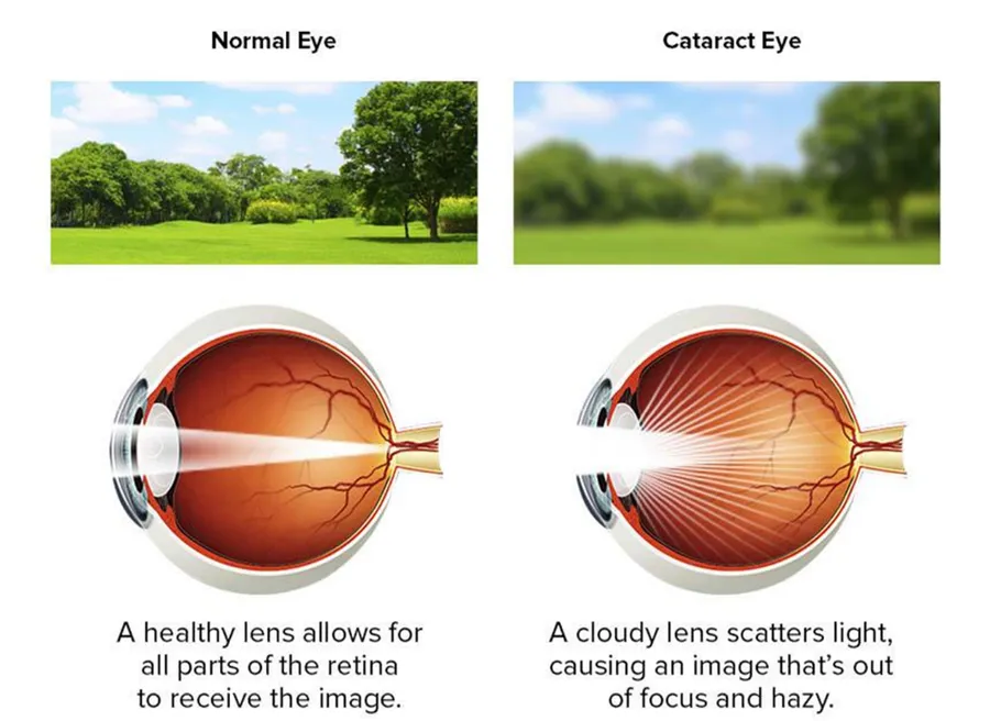 Cataract – Symptoms