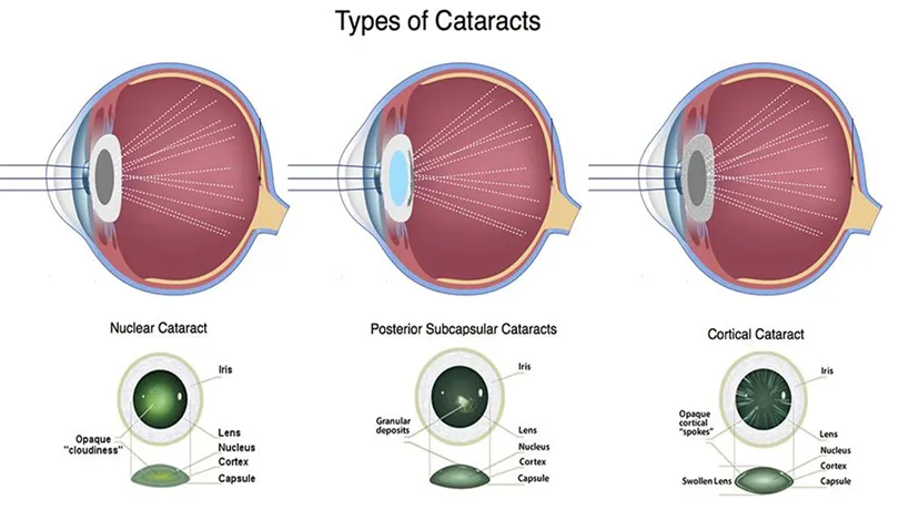 Cataract – Symptoms