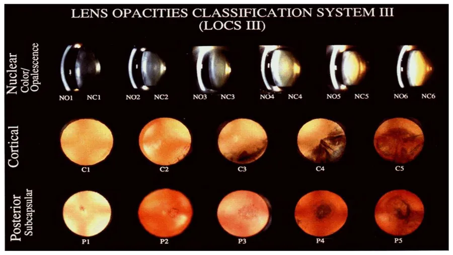 Cataract – Symptoms