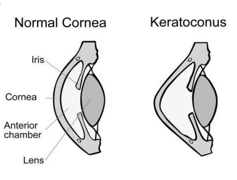 Corneal Ectasia – Keratoconus – Definition of Keratoconus
