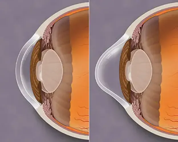 Corneal Ectasia – Keratoconus – Definition of Keratoconus