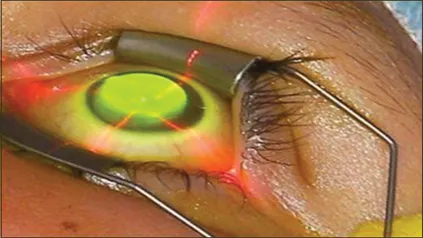 Corneal Ectasia – Keratoconus – Surgical treatment in case of progression of Keratoconus