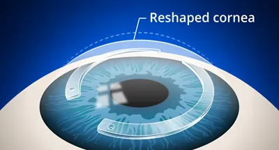 Corneal Ectasia – Keratoconus – Surgical treatment in case of progression of Keratoconus