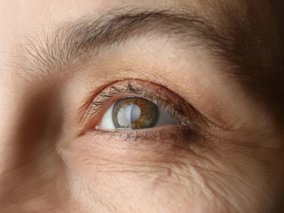 Cataract Surgery – Dr. Alpa Atul Poorabia
