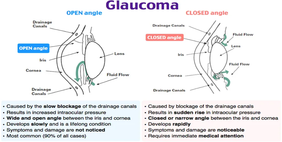 Glaucoma – How Eye works normally and how Glaucoma happens