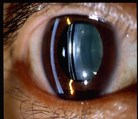 PHAKIC Intraocular Lens – Phakic Intra-ocular Lens (PIOL)