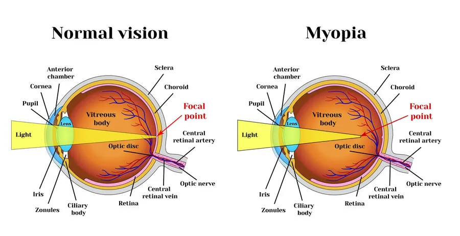 Refractive Errors And Solutions – Myopia (Near-sightedness)
