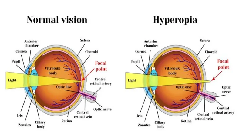 Refractive Errors And Solutions – Hypermetropia (Hyperopia)