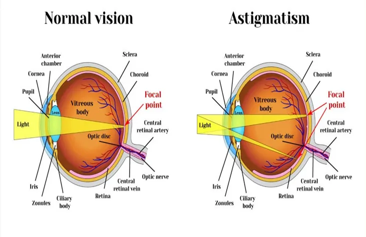 Refractive Errors And Solutions – Astigmatism