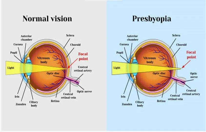 Refractive Errors And Solutions – Astigmatism