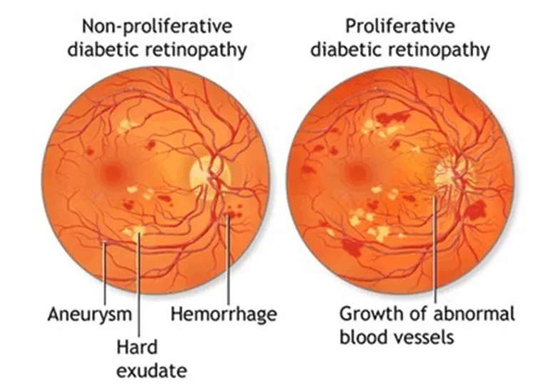 Systemic Diseases & Eye – DM & EYE