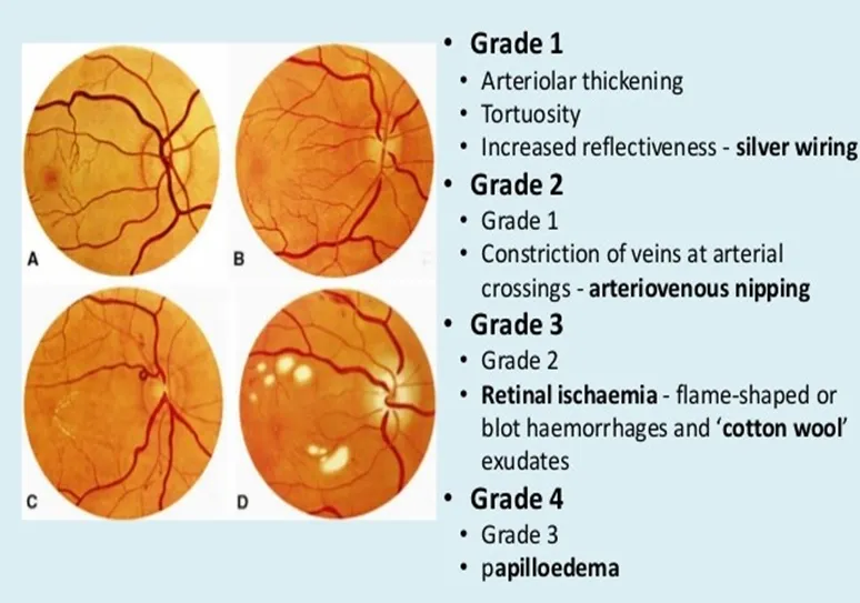 Systemic Diseases & Eye – HT & EYE